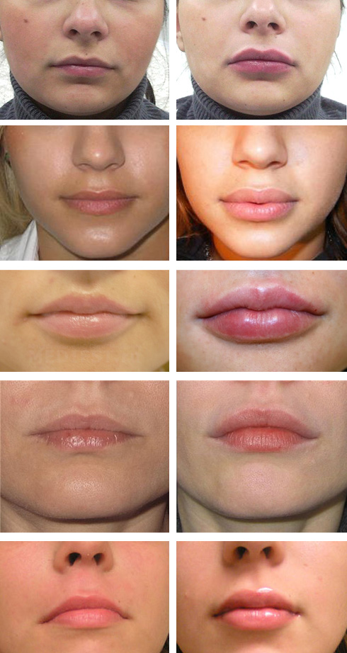 до и после операция на губы